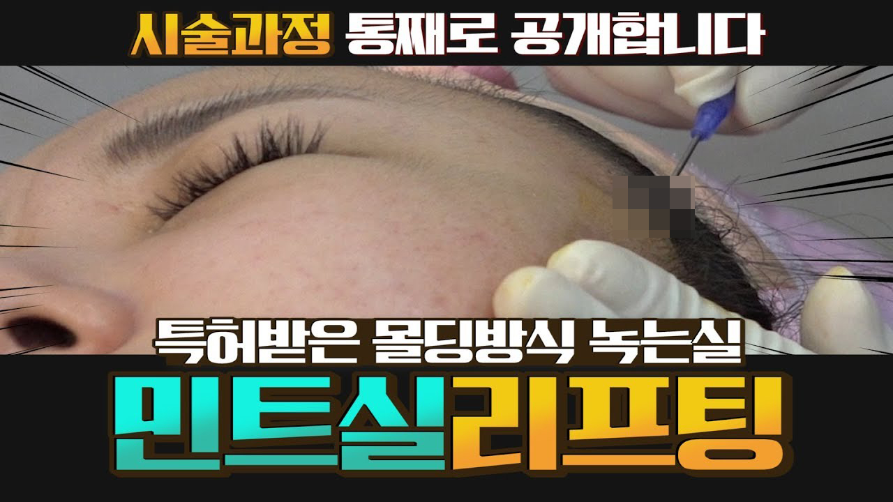 민트실리프팅 리얼시술과정 공개합니다 썸네일