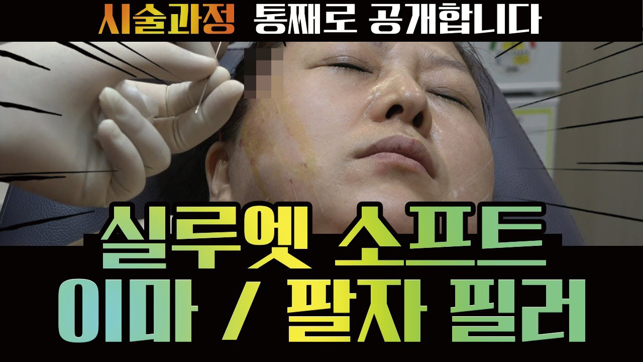 실루엣 소프트 팔자필러 이마필러 리얼시술과정 공개합니다 썸네일